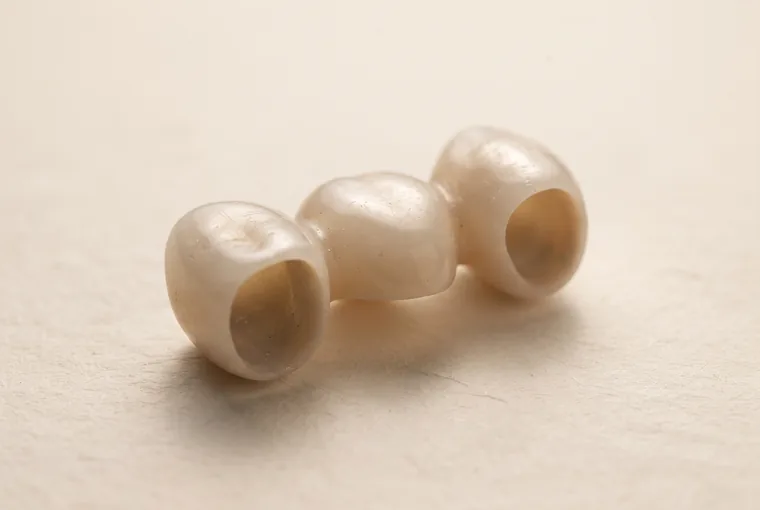 A three-unit porcelain dental bridge seen from below