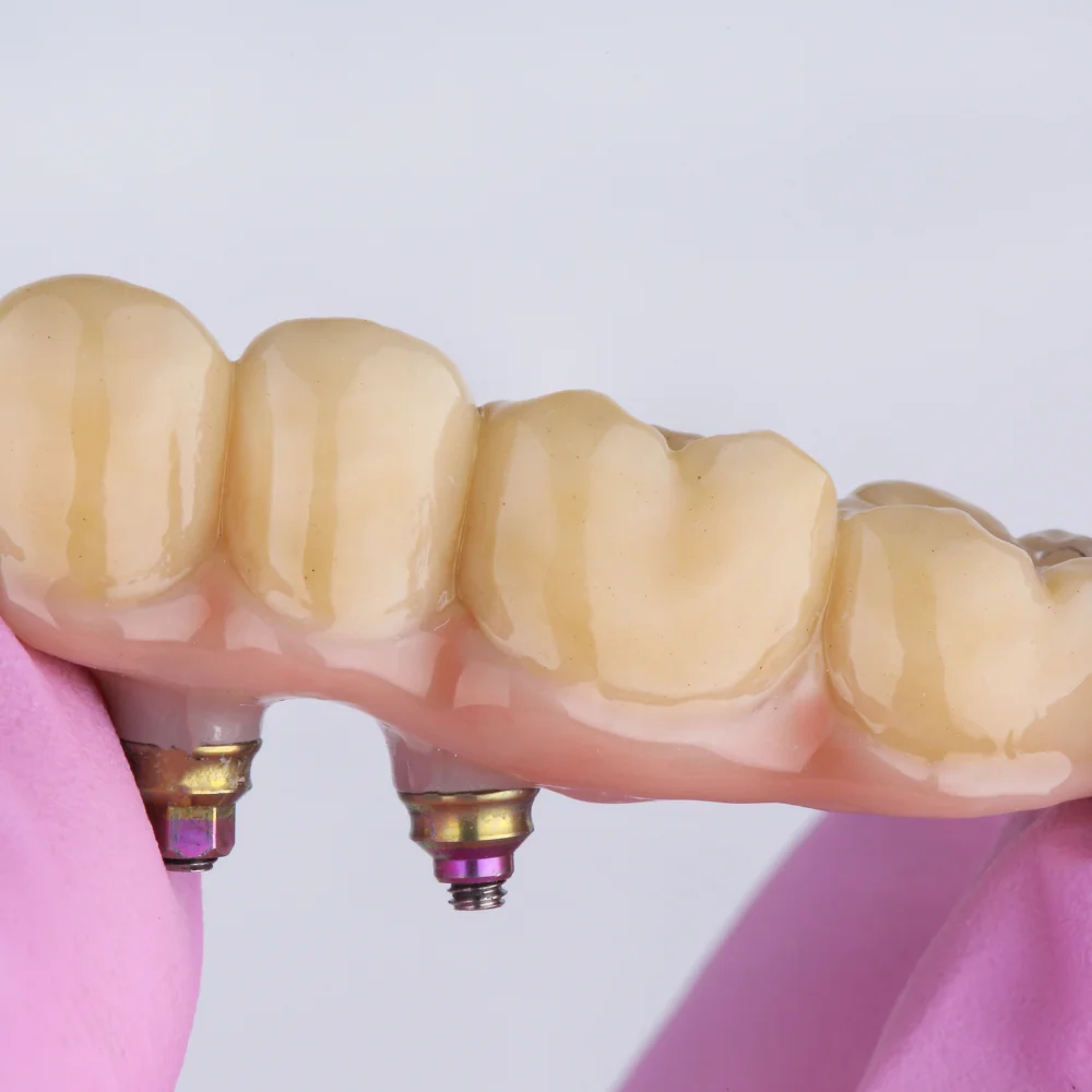 Implant-supported dental restoration bridge designed to replace missing teeth naturally