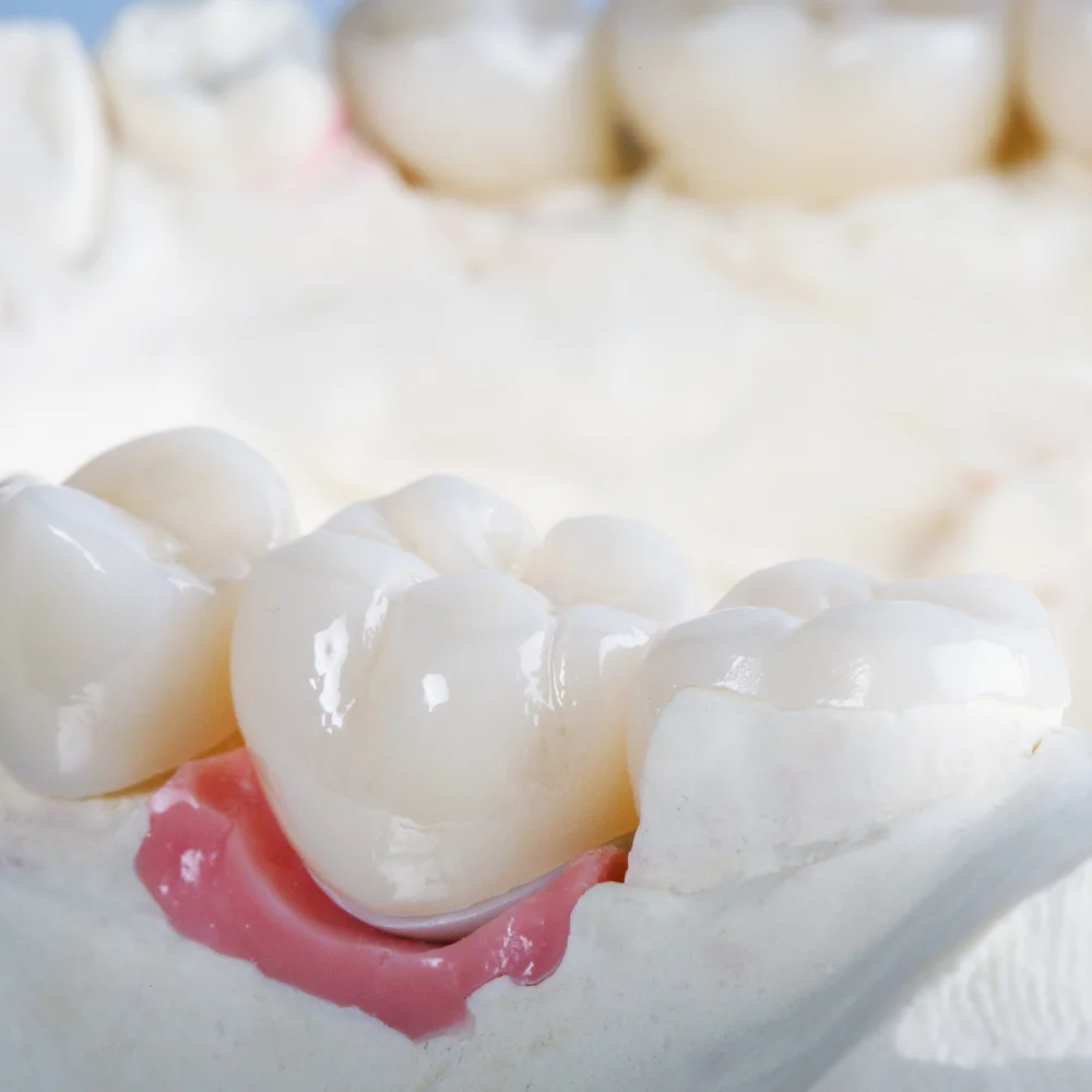 Close-up of ceramic dental crown restoration placed on a dental model for tooth repair