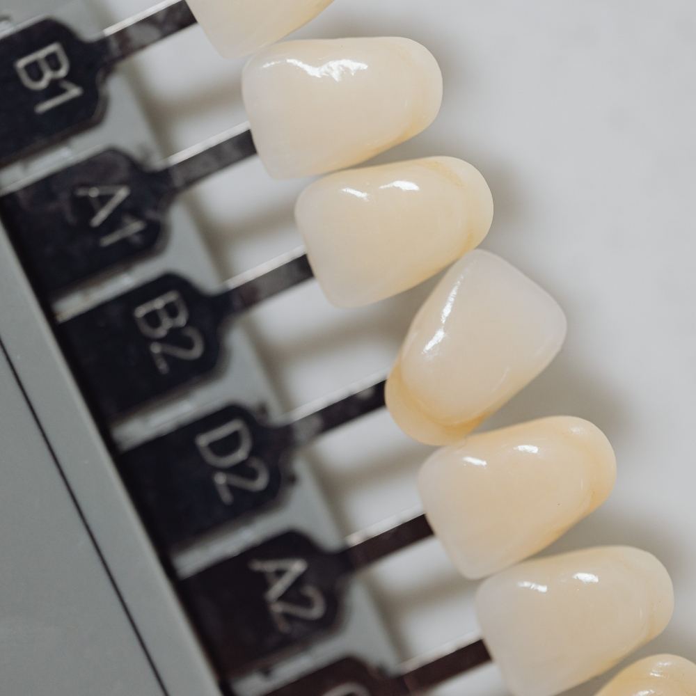 Close-up of porcelain veneer color samples used for custom cosmetic dental restorations