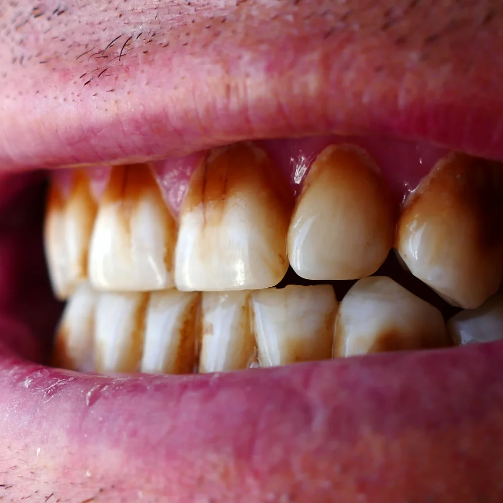 Close-up of stained teeth before undergoing professional teeth whitening treatment