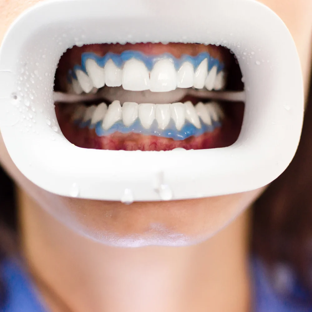 Close-up of white teeth during a professional teeth whitening treatment session