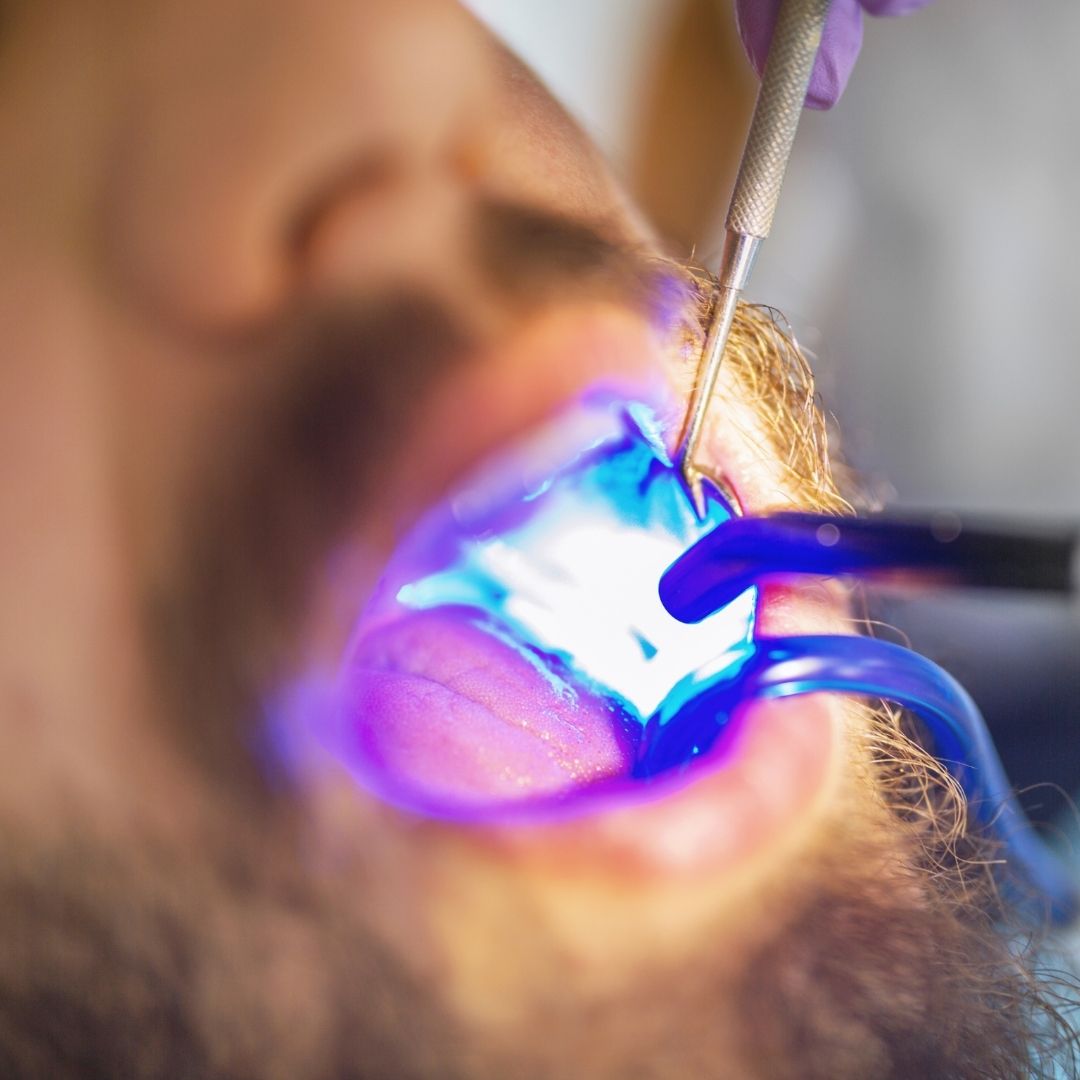 Close-up of Solea laser dentistry procedure used for precise and minimally invasive dental treatment
