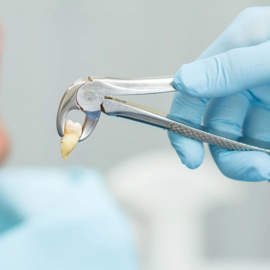 Dentist holding extracted tooth with dental extraction forceps after tooth removal procedure