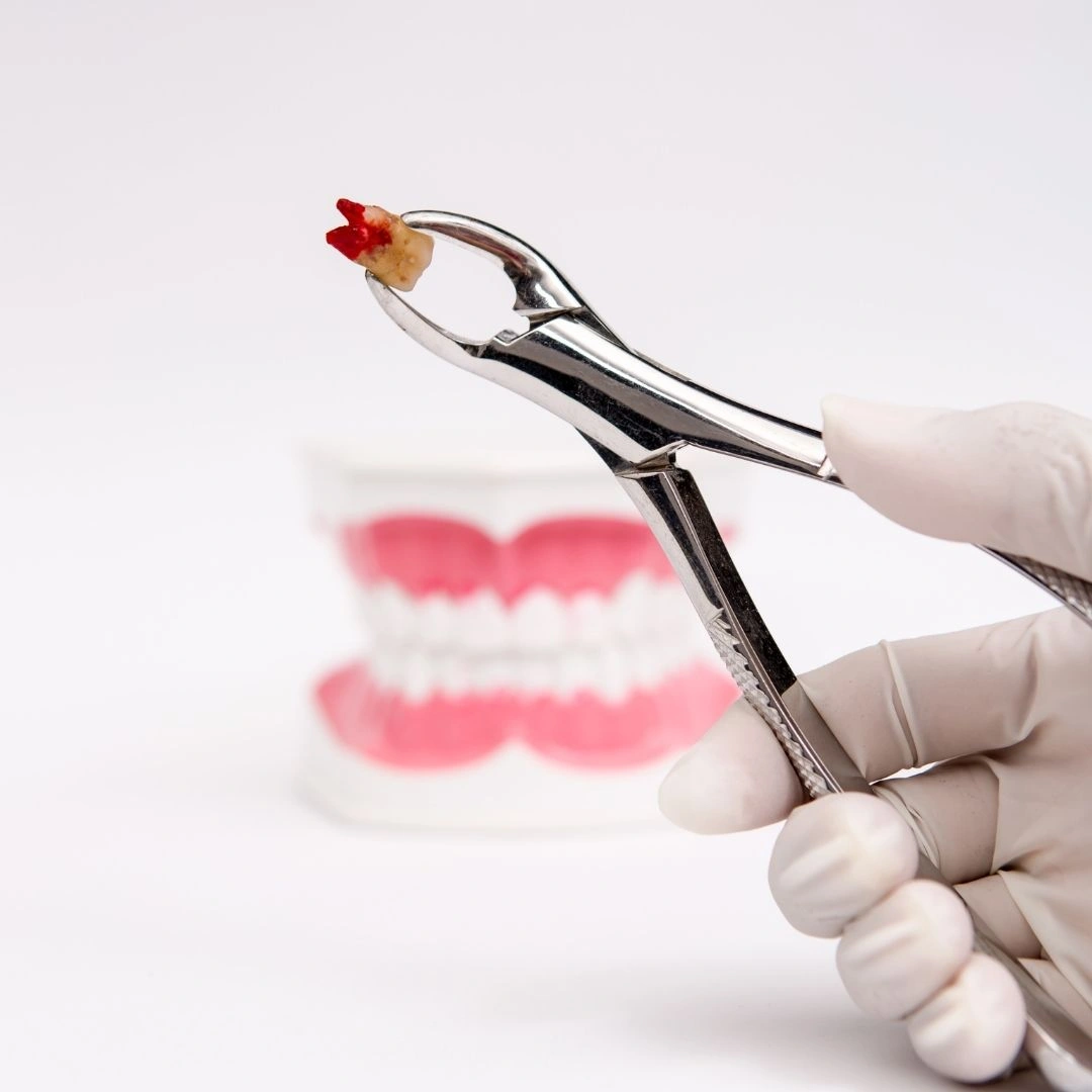 Close-up of extracted tooth in dental forceps during oral surgery and tooth extraction treatment
