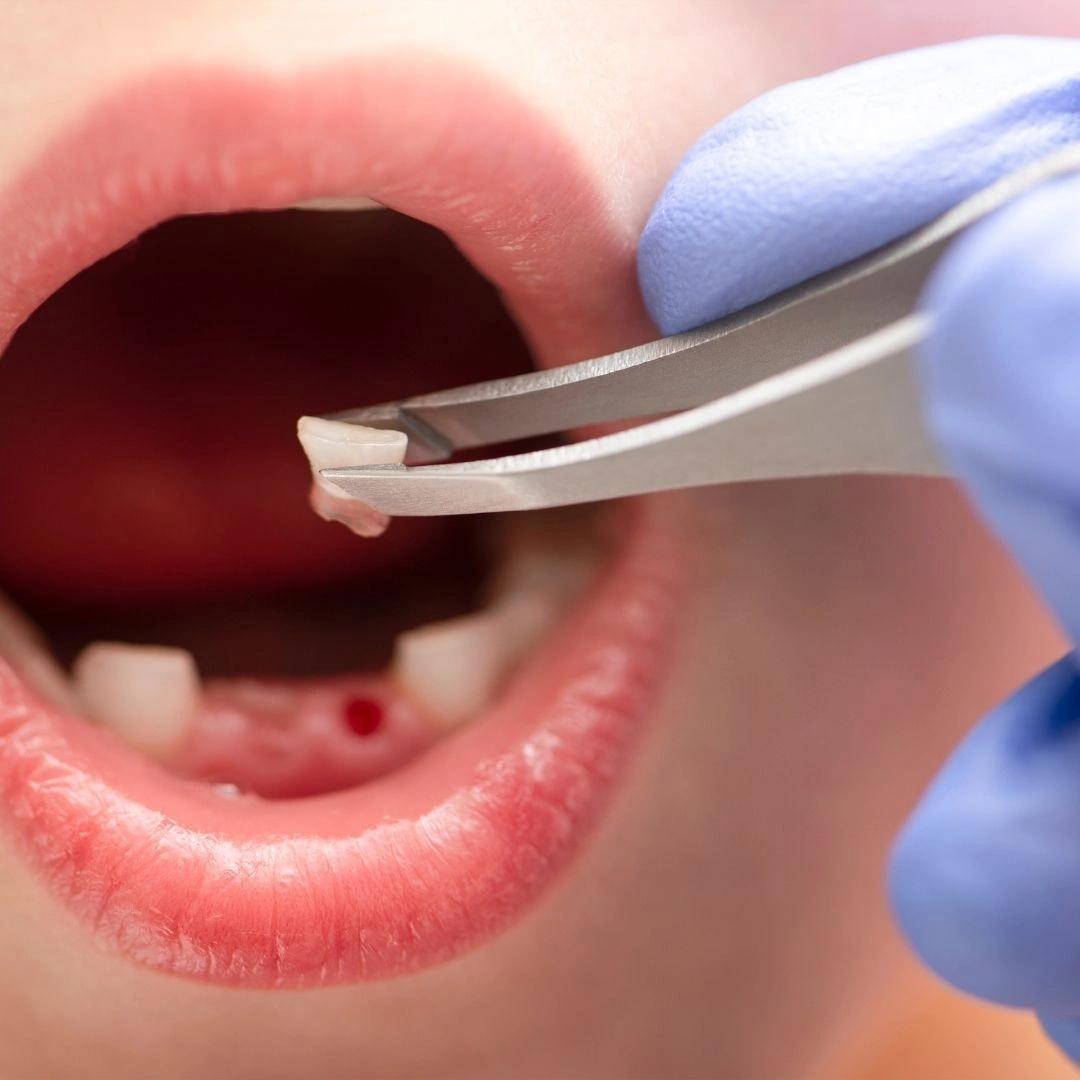 Close-up of tooth extraction site after removal procedure with dental tweezers and oral care treatment