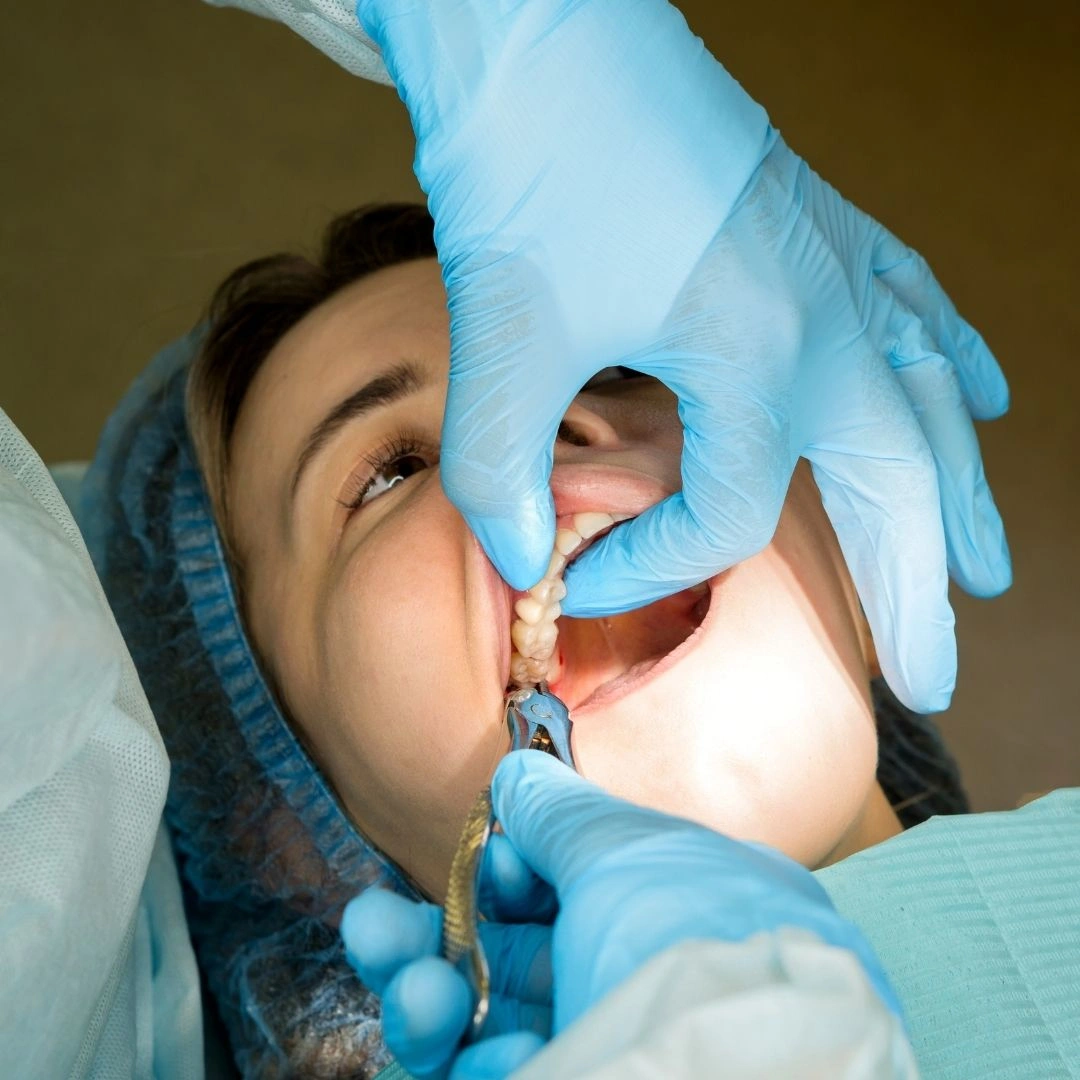 Oral surgeon performing wisdom tooth extraction using specialized dental instruments and techniques