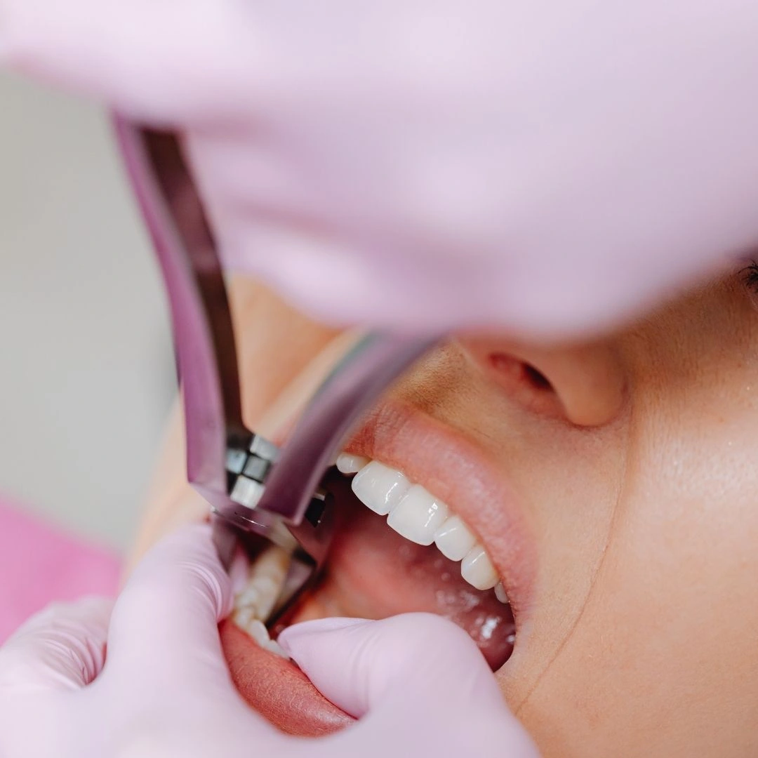 Dentist performing safe and comfortable dental extraction procedure for damaged tooth removal